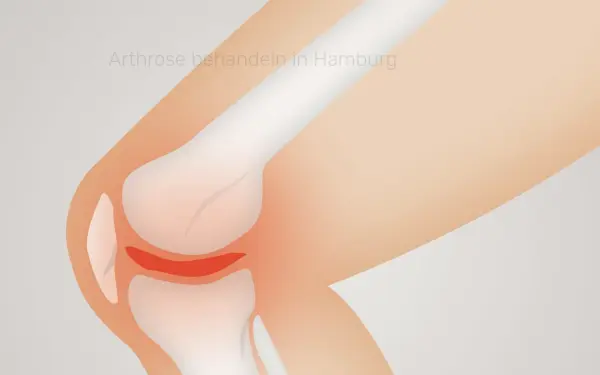 www.arthrosetherapie-hamburg.de